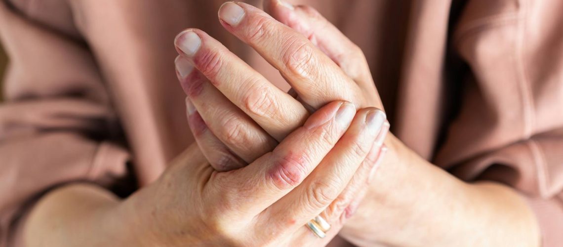 Psoriasis mains-pieds : le tabagisme augmente le risque